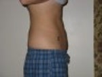 2 months after smart lipo - side